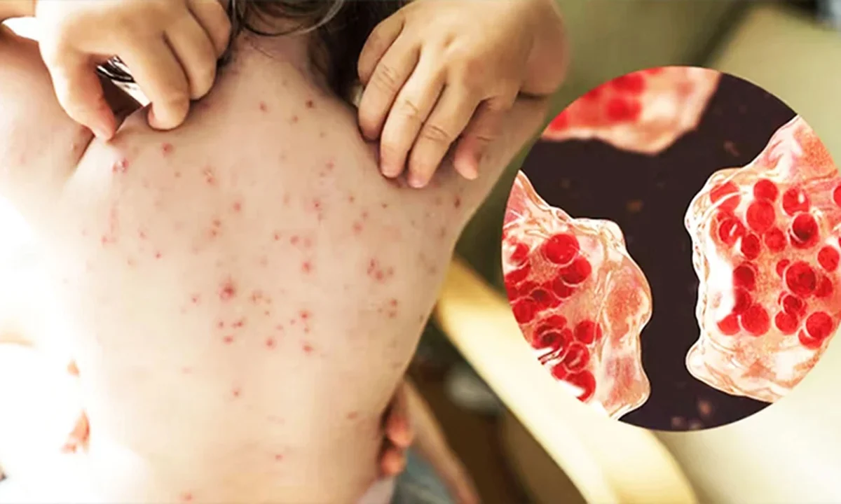 দেশে হামের ২০ জেলায় ৩০ ‘হটস্পট’ ঘোষণা; আগামীকাল থেকে বিশেষ টিকাদান কর্মসূচি